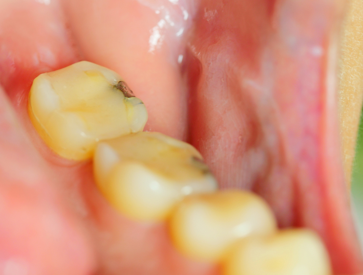 Fissure dental fillings, Medically accurate
